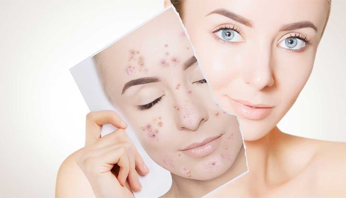 عوارض کرم روشن کننده سی گل حاوی هیدروکینون 4 کاربرد کرم روشن کننده سی گل